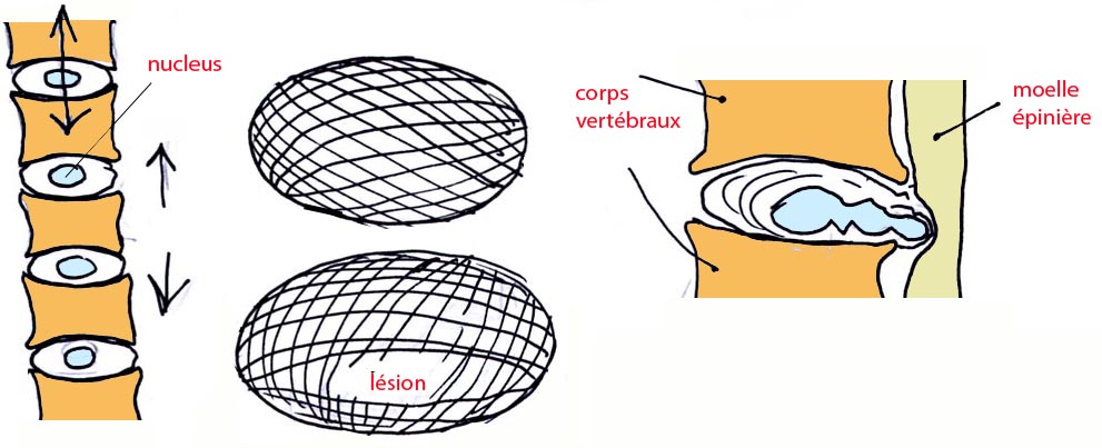 hernie discale